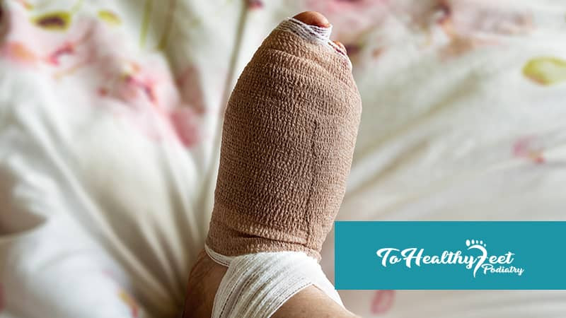 To healthy feet - blog - Hammer Toe Surgery And Recovery What To ﻿Expect